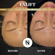 【✨小顔×艶肌ケア】EX LIFT｜むくみ・たるみ・透明感まで同時アプローチ〈メンズOK〉