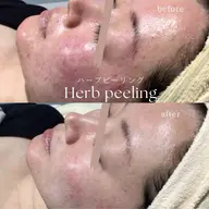 【ミニモ限定】 国産ハーブピーリング🌿/ダウンタイムなし/剥離なし/当日メイクOK/話題の次世代ハーブピーリング