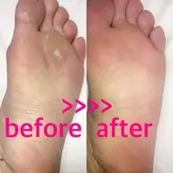 フット角質ケア