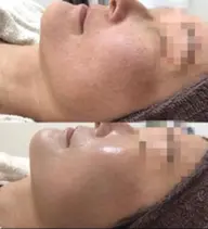 皮膚科学に基づいたハーブピーリング 🌿