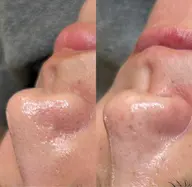 【毛穴レス肌】陶器のような凹凸のないシルク肌に！！毛穴撲滅/国産人臍帯血幹細胞＆毛穴縮小アンプル高速導入