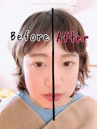 美容鍼＋ヒト幹細胞導入鍼