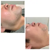 顔脱毛(髭脱毛)