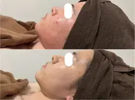 【オススメNo.1】くすみOFF！透き通るようなツヤ肌へ。高濃度炭酸パック¥5500