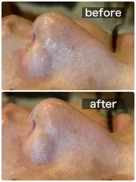 【日にち&撮影に協力いただける方限定】ハイドラ毛穴洗浄コース(＋ワックスorポレーション)