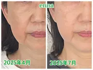 【ほっぺ集中ケア】厚く重くなりがちなホホをシュッとスッキリ！