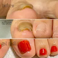 【オフ無し】両親指巻き爪矯正•ジェルネイルワンカラー仕上げ