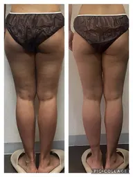 《即効美脚》下半身ハイパーナイフ×強圧リンパマッサージ