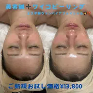 美容鍼➕WiQo®️ワイコ水光ピール