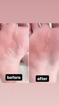 ウオノメ タコ+角質ケアセットと同時予約で3300引き致します。