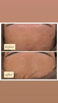 ハーブピーリング🍃◎毛穴の開き・黒ずみ ◎ニキビ・ニキビ跡 ◎くすみ・ザラつき