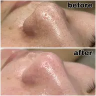 【毛穴汚れ・ざらつき撃破!】毛穴洗浄シェービング