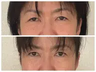 【目元＆おでこ集中ケア】額スッキリパッチリ目元へ