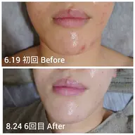 《REVハーブピーリング》ニキビ、毛穴、お肌のゴアつきケアケア！マッサージ付！オプション¥4400相当プレゼント☆