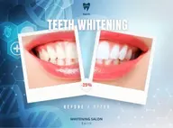 《ミニモ学割》U24 歯科提携セルフホワイトニング40分照射