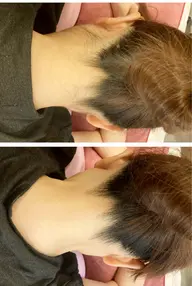 【うなじ脱毛お試し】清潔感アップ✨後ろ姿に自信が持てるうなじ脱毛