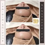 【当店で最上級美白ケア】ハーブピーリングダブル+毛穴洗浄+ポレーション