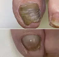 変形爪の再生補正モデルさん