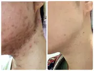 【くり返すニキビ肌から抜け出したい】再発防止x赤み鎮静x毛穴洗浄✨150通りの施術からあなたにピッタリの施術をご提供🌈