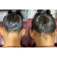 【うなじ】ダブル脱毛で最短ツルスベに✨Wax脱毛+SHR光脱毛