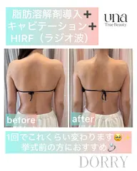 【初回限定】キャビテーション&ラジオ波でスッキリ!以下より1部位限定!(太もも裏、面、ふくらはぎ、お腹、背中、二の腕)