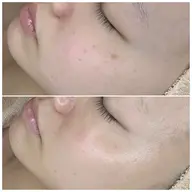 【シミの量が少なめな方】シミデトックストリートメント70分