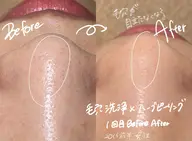 【肌質改善🌿人気NO2】全顔剥離なしハーブピーリング+毛穴洗浄鼻のみ 50分¥7000→¥5000