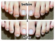 【FOOT】ネイルケア【巻き爪予防】足爪ファイル・甘皮ケア・ベースコート🦶妊婦さん・ご年配の方にも✨