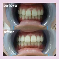 セルフホワイトニング30分照射