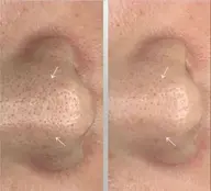 《初回限定》韓国発!SJ究極の毛穴ケアトリートメント+小顔ケア うる艶水光肌 100分