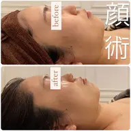 【ハイパーナイフEX美小顔コルギ80分】肌表面から深部までお肌のご褒美ケア♪