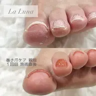 💙　フット 巻き爪ケア(1本)