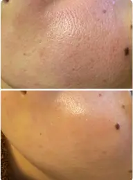 リピーター様限定🩵【剥離なし】ハーブトリートメント🌿お肌の悩み、状態にに合わせてのオプション付⭐️