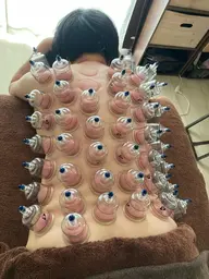 背面全身カッピング