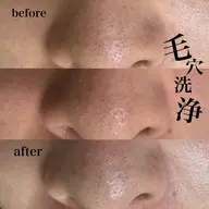 【毛穴黒ずみ撃退💥】韓国式美肌毛穴洗浄 -鼻のみ👃🏻-