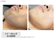 全顔or VIO脱毛モデル(男性の方は全顔のみ)                      募集致します。