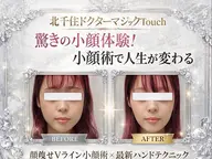 【ミニモ限定】人気No.1★劇的Vライン形成＋強力リフトアップ矯正｜たるみ・エラ張り撃退「施術50分​〜​」