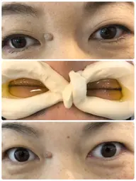 眼球エステ ネトラバスティ  眼精疲労 ドライアイ 白目クリーニング