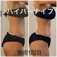 【痩身人気No.1】ハイパーナイフ全身 リンパマッサージ付き150分