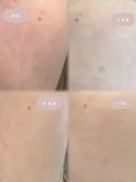 赤ちゃん肌を目指す！シミケア🌿ハーブピーリング＋アフターフォロー付