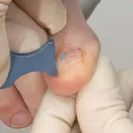 巻き爪矯正（自爪のみ）