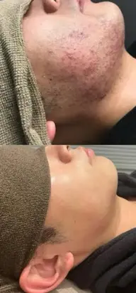 【脱毛・男性】★ひげ+頬部位★ 激安価格で超お得※ご来店前に髭剃り必要