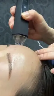 プラズマニードル　エクソソーム付き