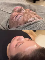 ニキビ肌改善トリートメント（マシン付き）