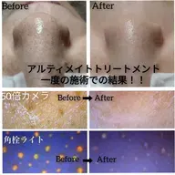 頑固な黒ずみ撃退‼️徹底毛穴洗浄毛穴レスアルティメイトコース🌟黒ずみ ニキビ ニキビ跡 毛穴縮小⭕️全顔水素吸引付‼️