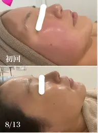 フェイシャルピーリング