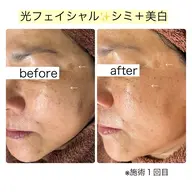 光フェイシャル