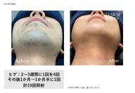 顔　部分脱毛