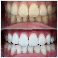 👩🏻‍🎓学生必見👩🏻‍🎓 学生限定のホワイトニング✨️(口コミ投稿あり)