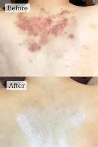 【ミニモ限定価格❤️‍🔥】背中まで輝く素肌へ☆ハーブピーリングで叶える上質ケア🌿初回¥22,000→¥13,000